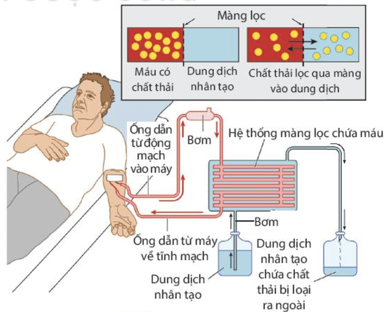 sơ đồ chạy thận nhân tạo